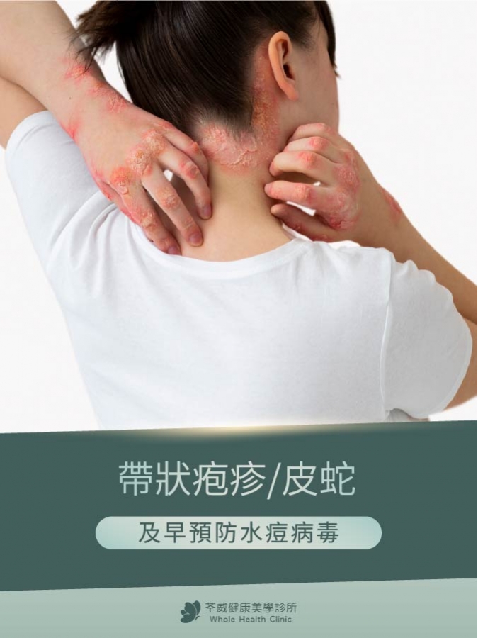 帶狀皰疹(皮蛇)