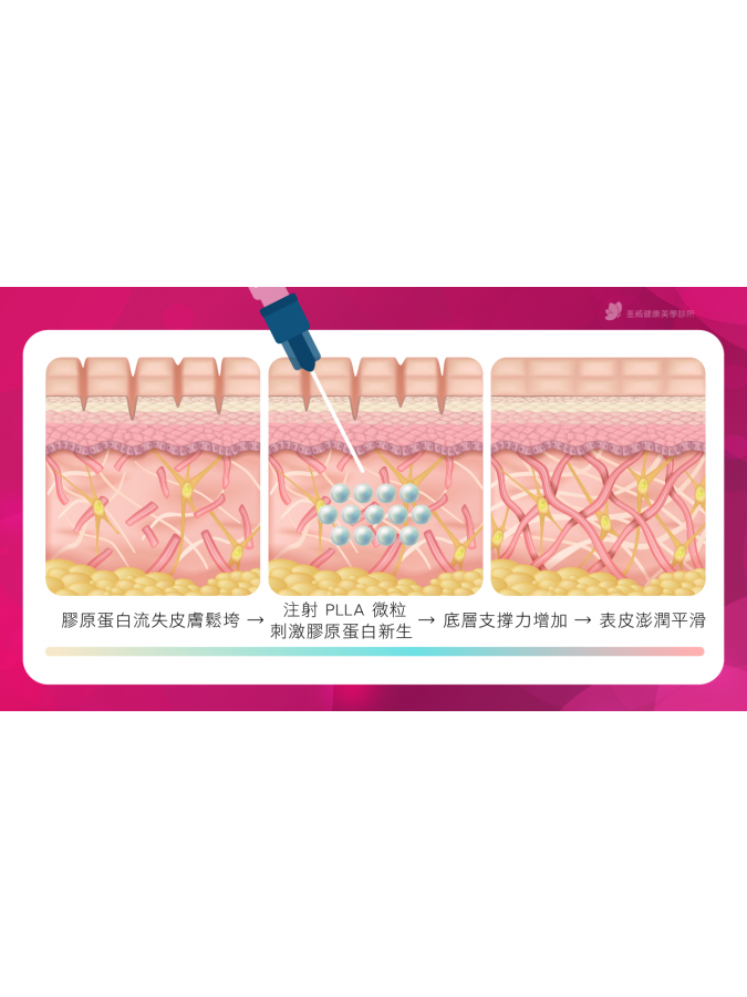 什麼是「4D童顏」?原理大公開 什麼是「4D童顏」?原理大公開