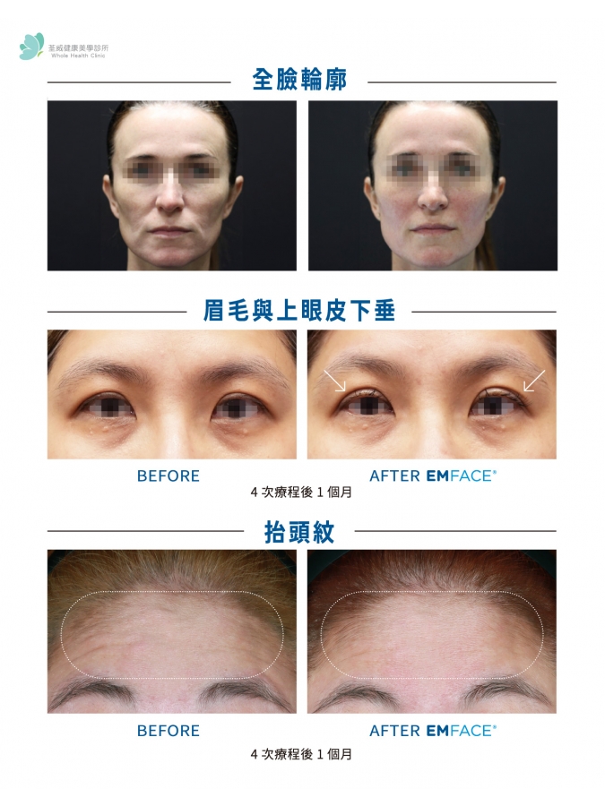 EMFACE 菲斯波|荃威診所・頂級抗老首選 EMFACE 菲斯波|荃威診所・頂級抗老首選