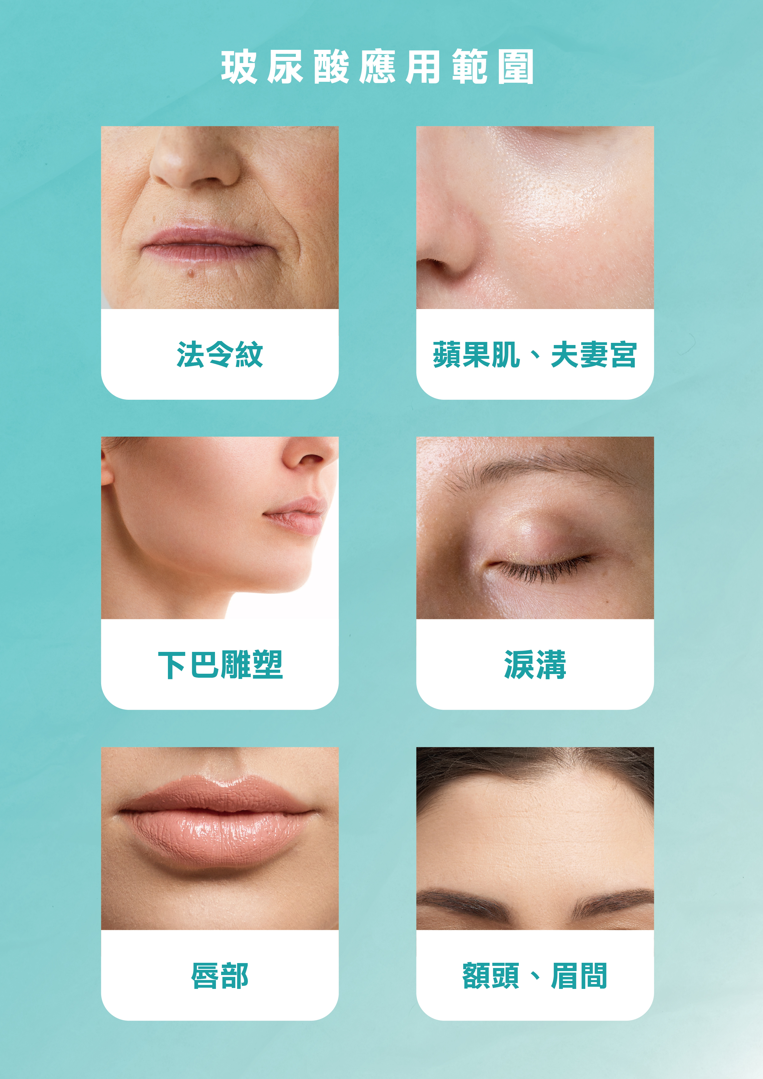 喬雅登玻尿酸的應用範圍