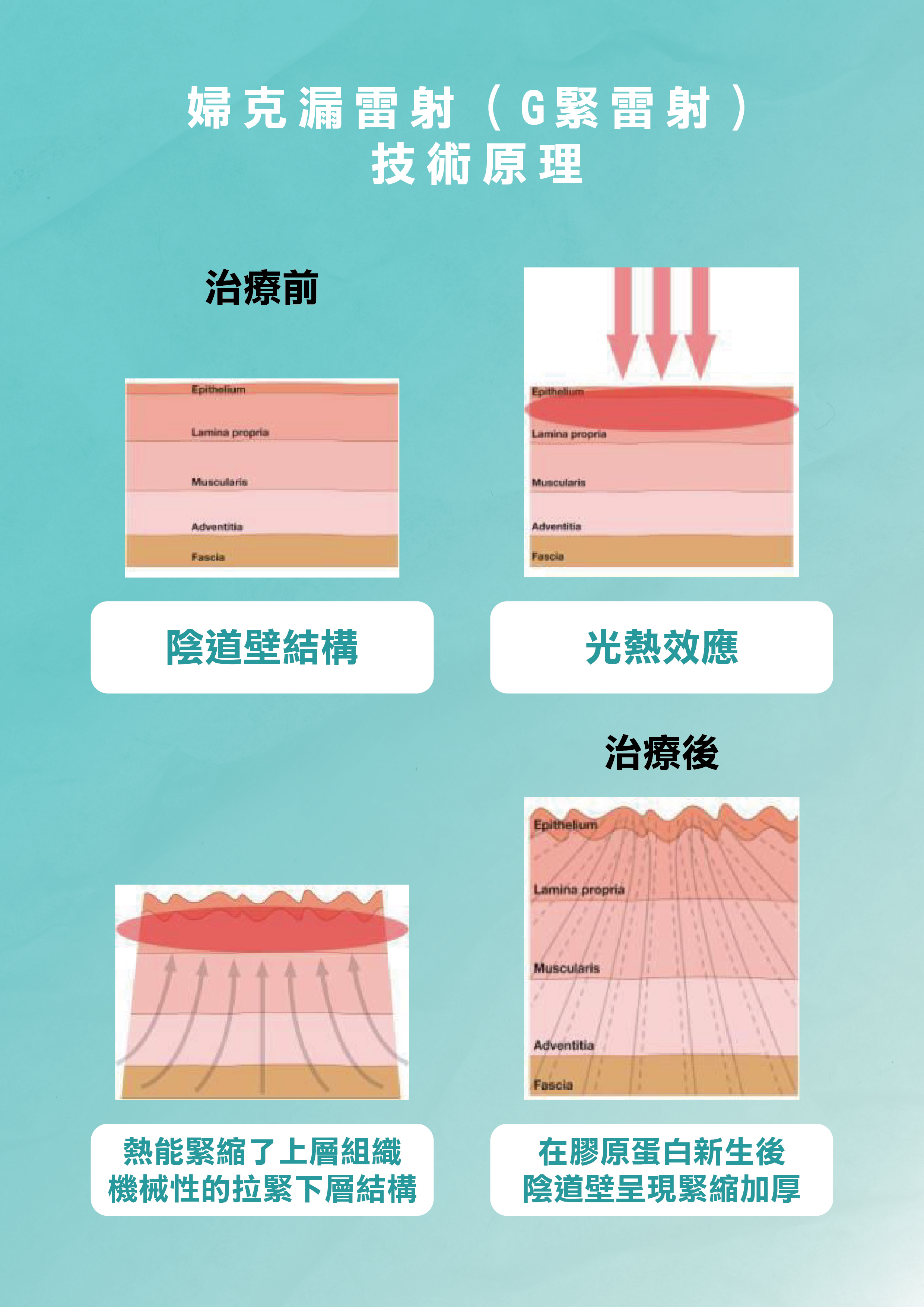 婦克漏雷射（G緊雷射）技術原理