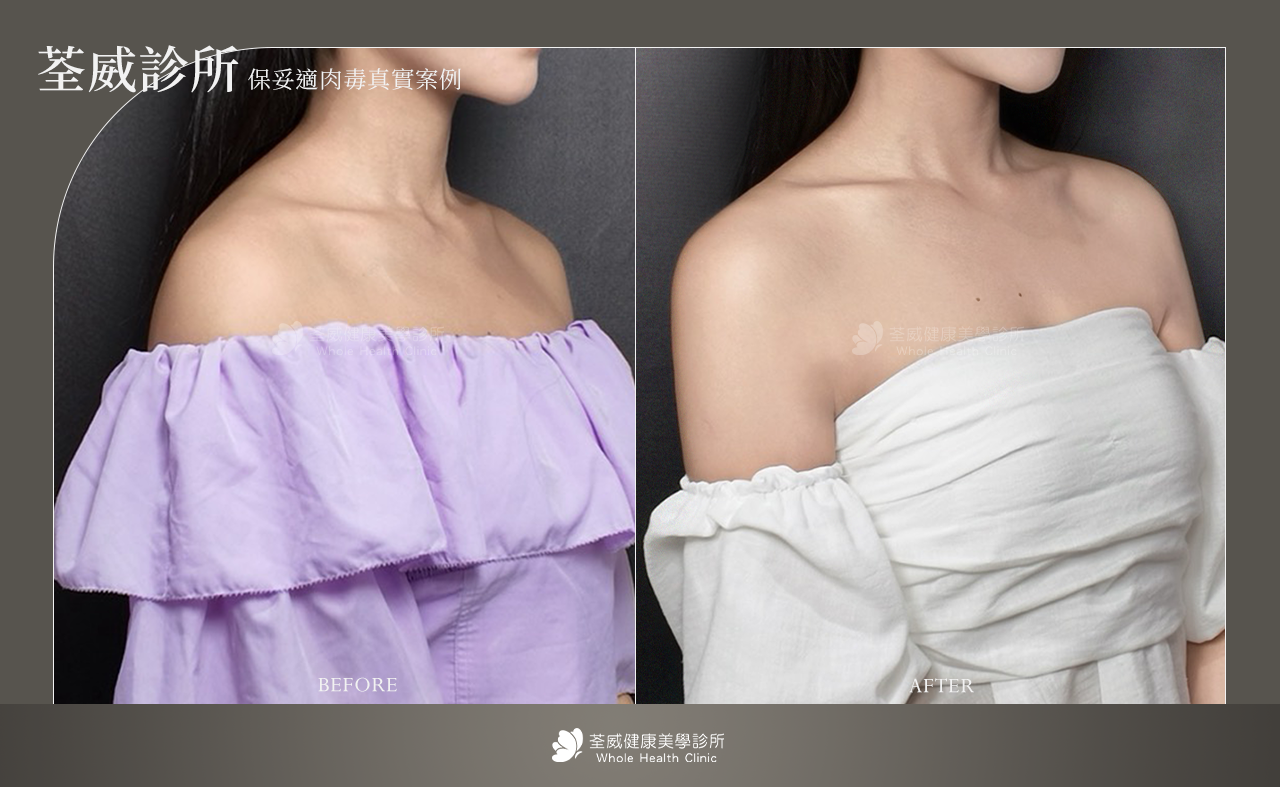 改善身體線條 (塑形)