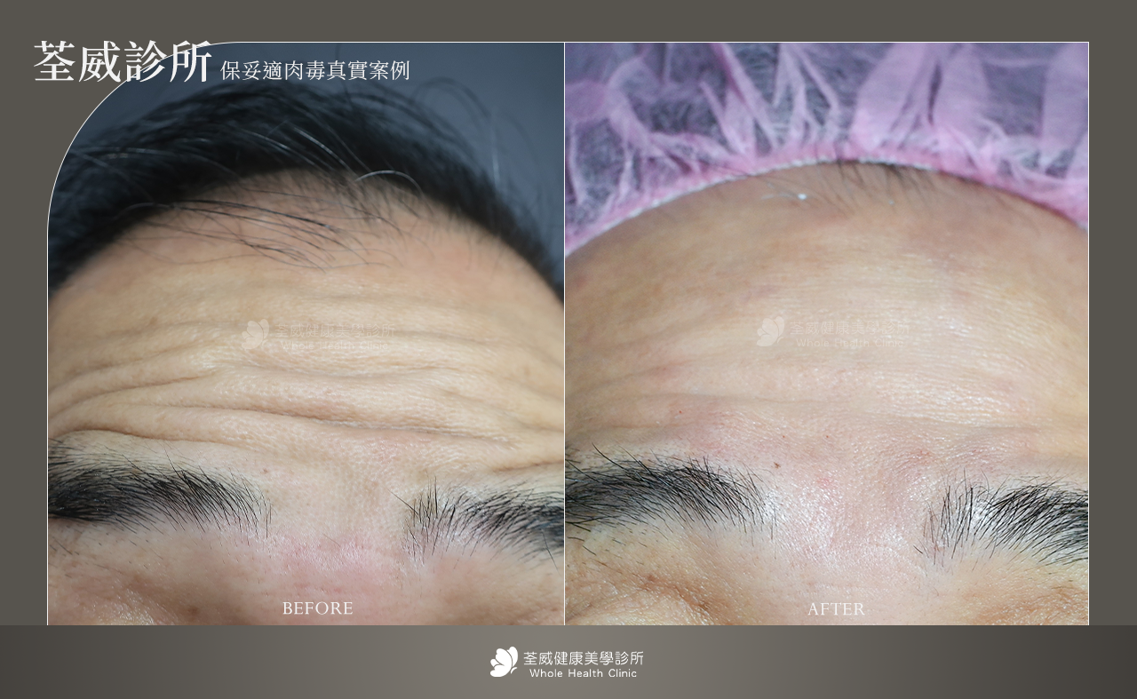 撫平動態紋路 (除皺)