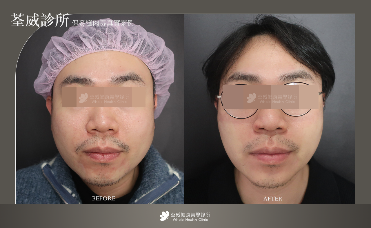 雕塑臉部輪廓 (瘦小臉)