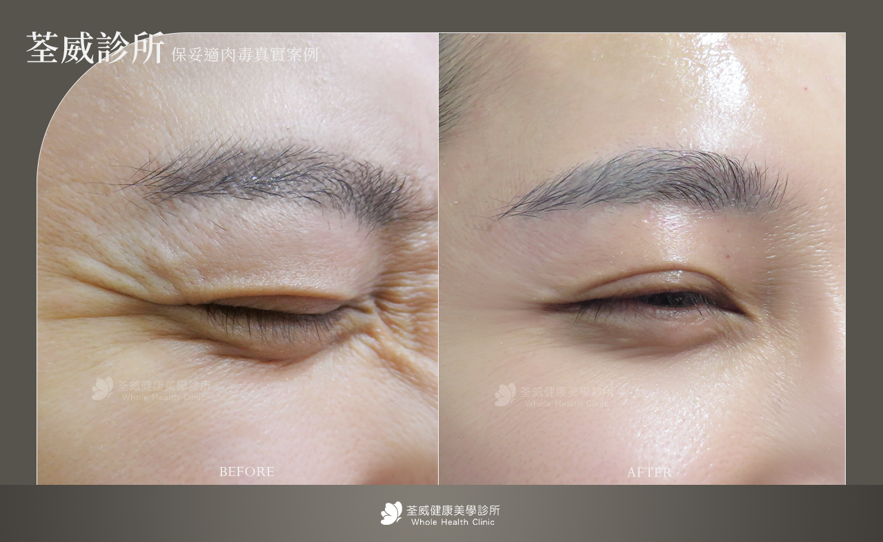 撫平動態紋路 (除皺)