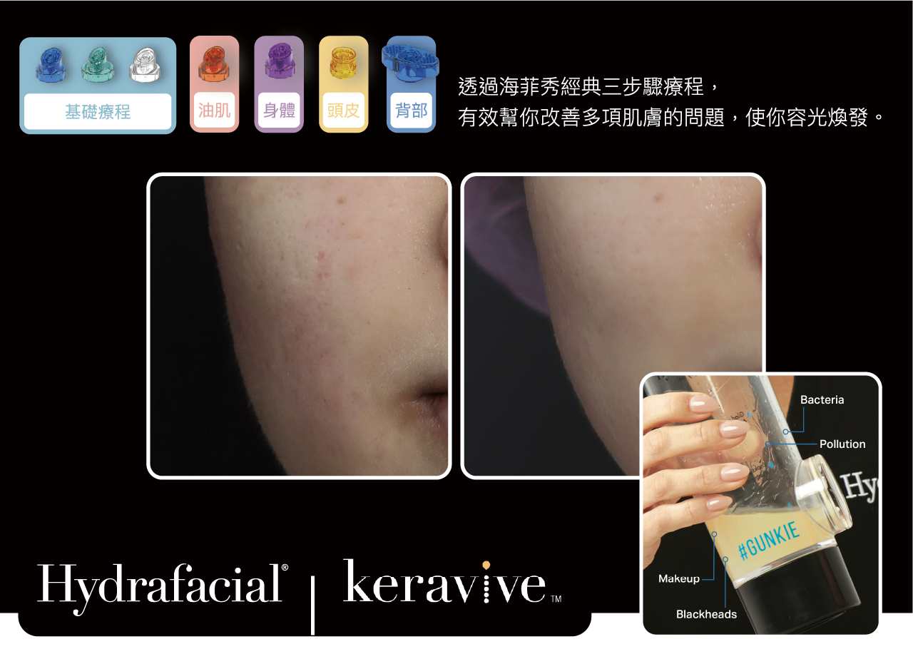 海菲秀療程後吸出的粉刺髒水瓶 海菲秀療程後吸出的粉刺髒水瓶