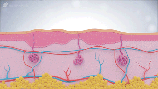 什麼是 LV音波2代?(Liftera V)