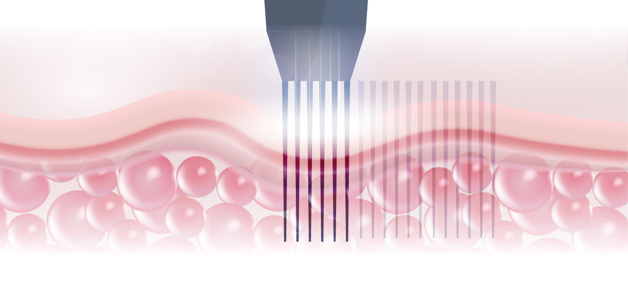 什麼是微針筆？從「微創」開始的膚質重建