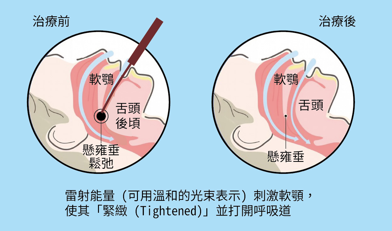 止鼾雷射是什麼？原理是？