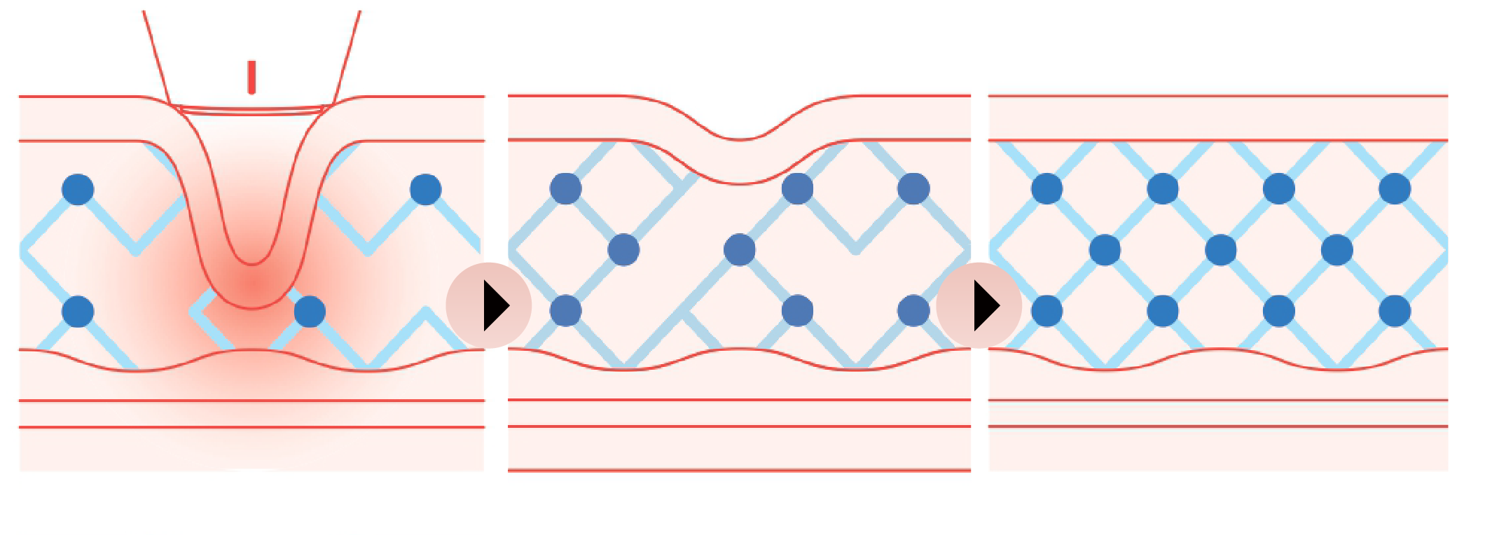 什麼是海芙電波？它與音波拉提有何不同？