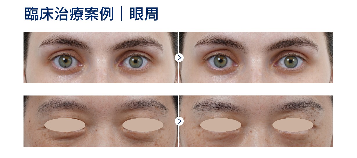 海芙音波媚必提實際治療案例