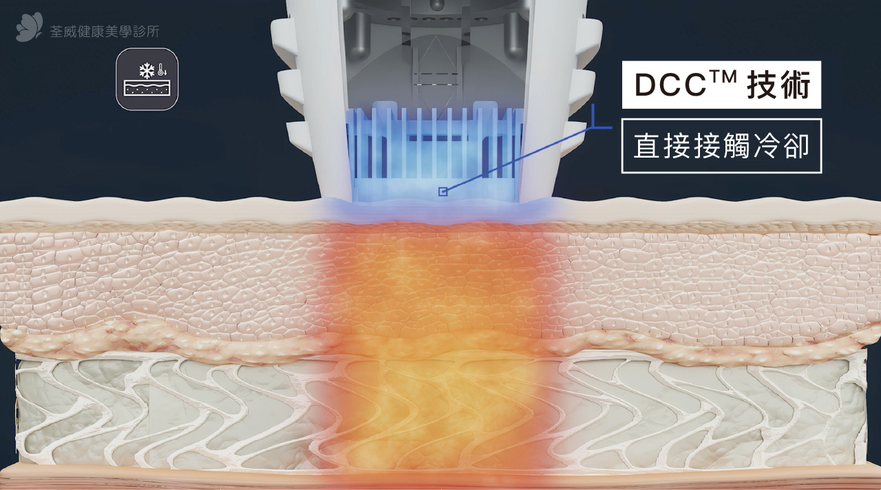 為什麼皇后電波比較不痛