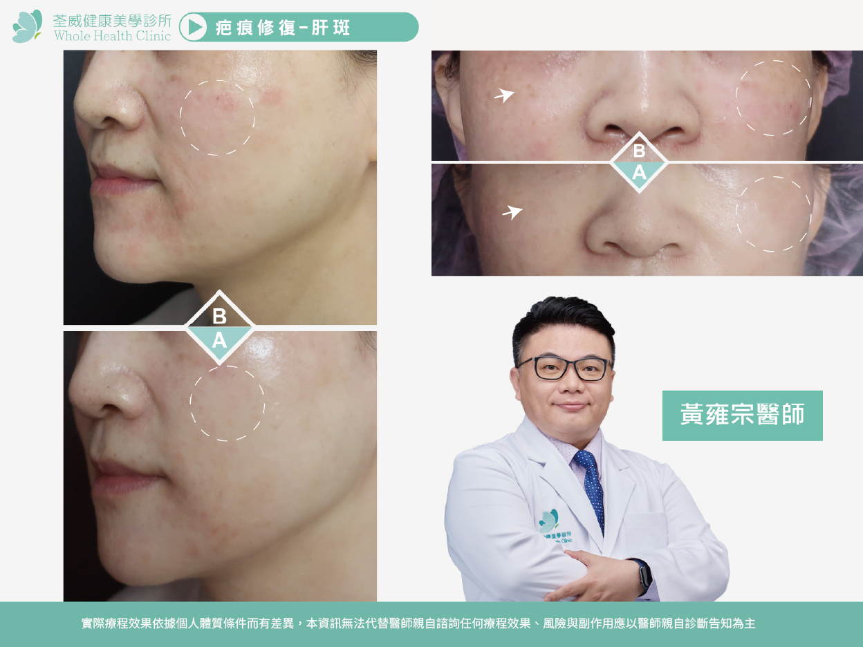 皮秒雷射肝斑BA
