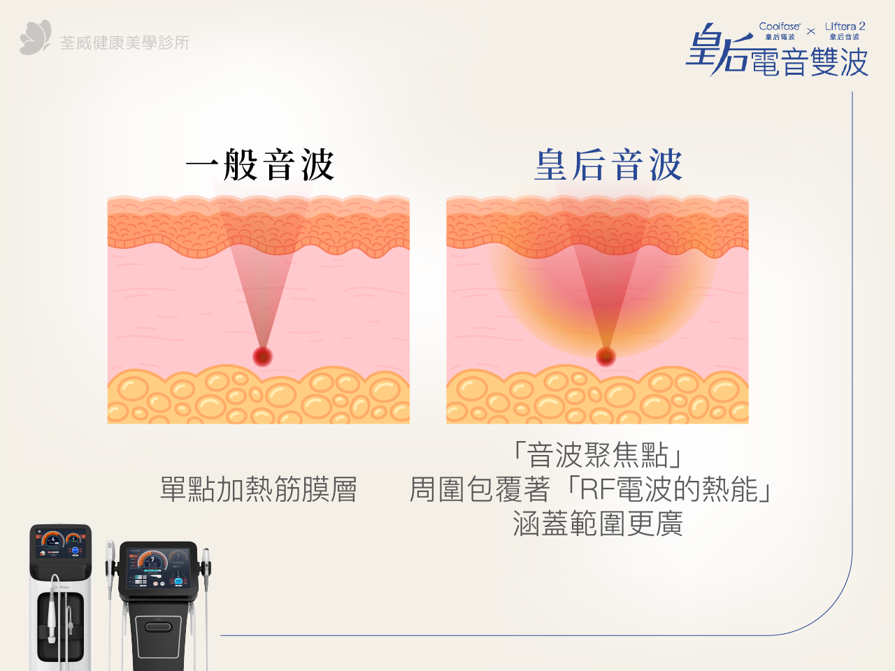 皇后音波 (New Doublo) 是什麼？揭開 MFU + RF 的雙重機密