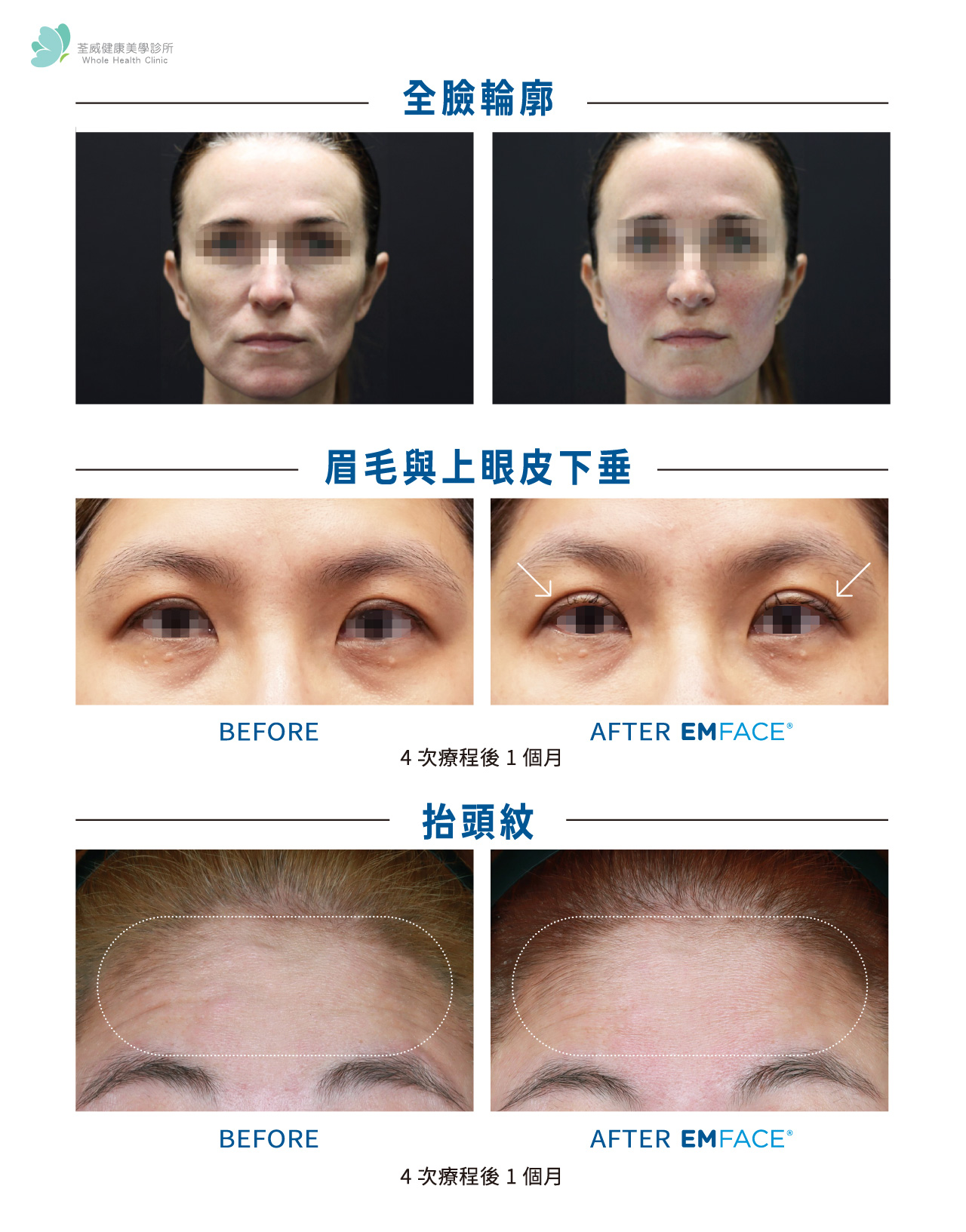 EMFACE 菲斯波｜荃威診所・頂級抗老首選