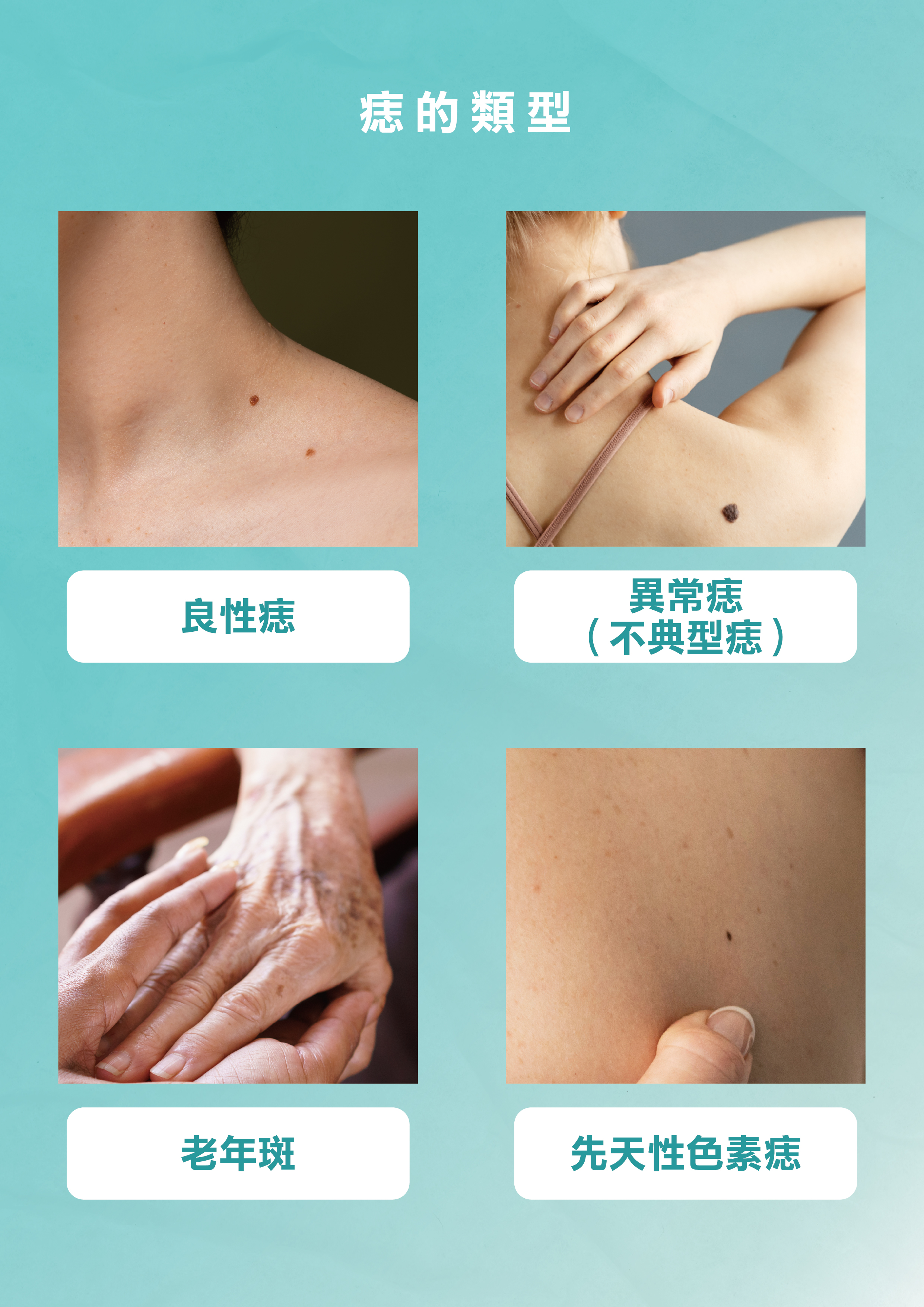 痣的醫學知識與除痣方法