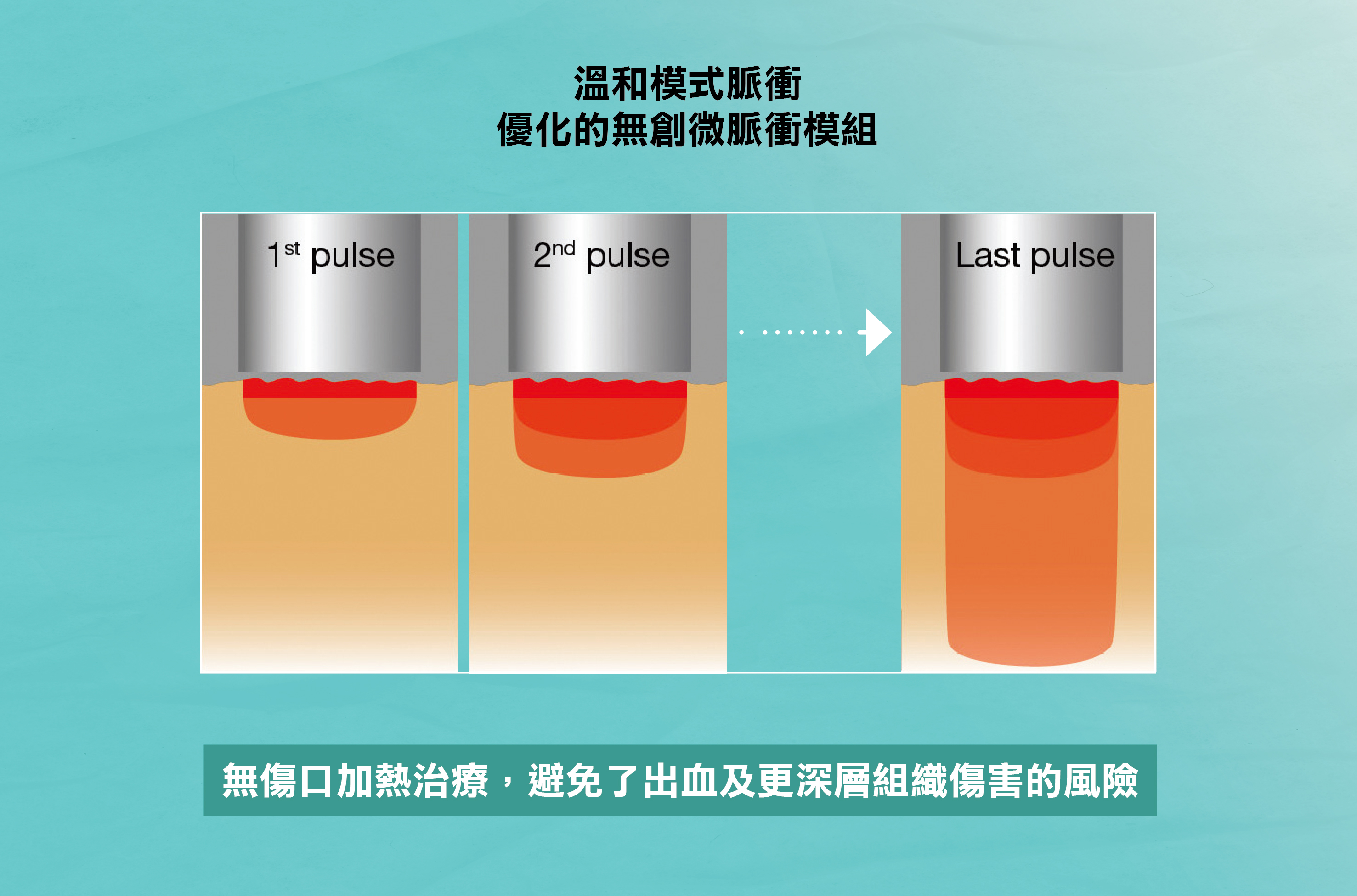 FOTONA汽化除痣