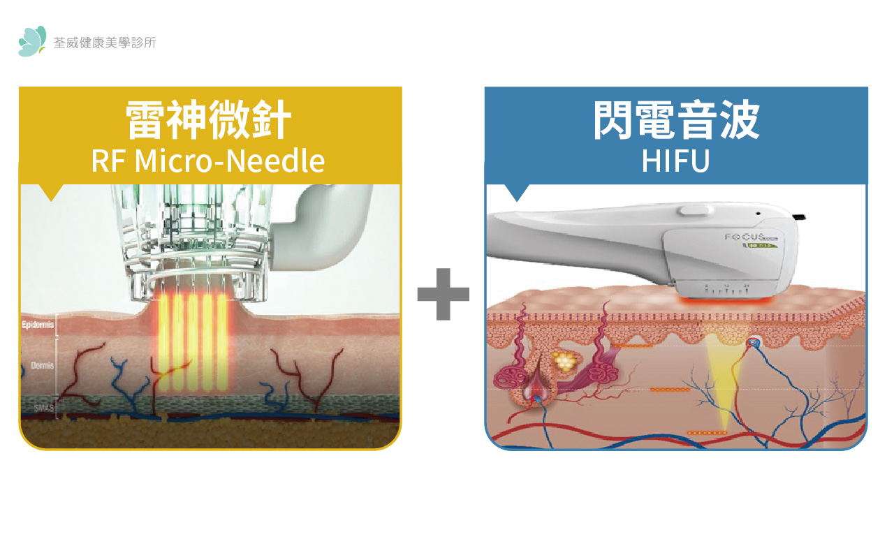  閃電音波技術（Ultrasound Therapy）| 台北第一醫美 荃威診所