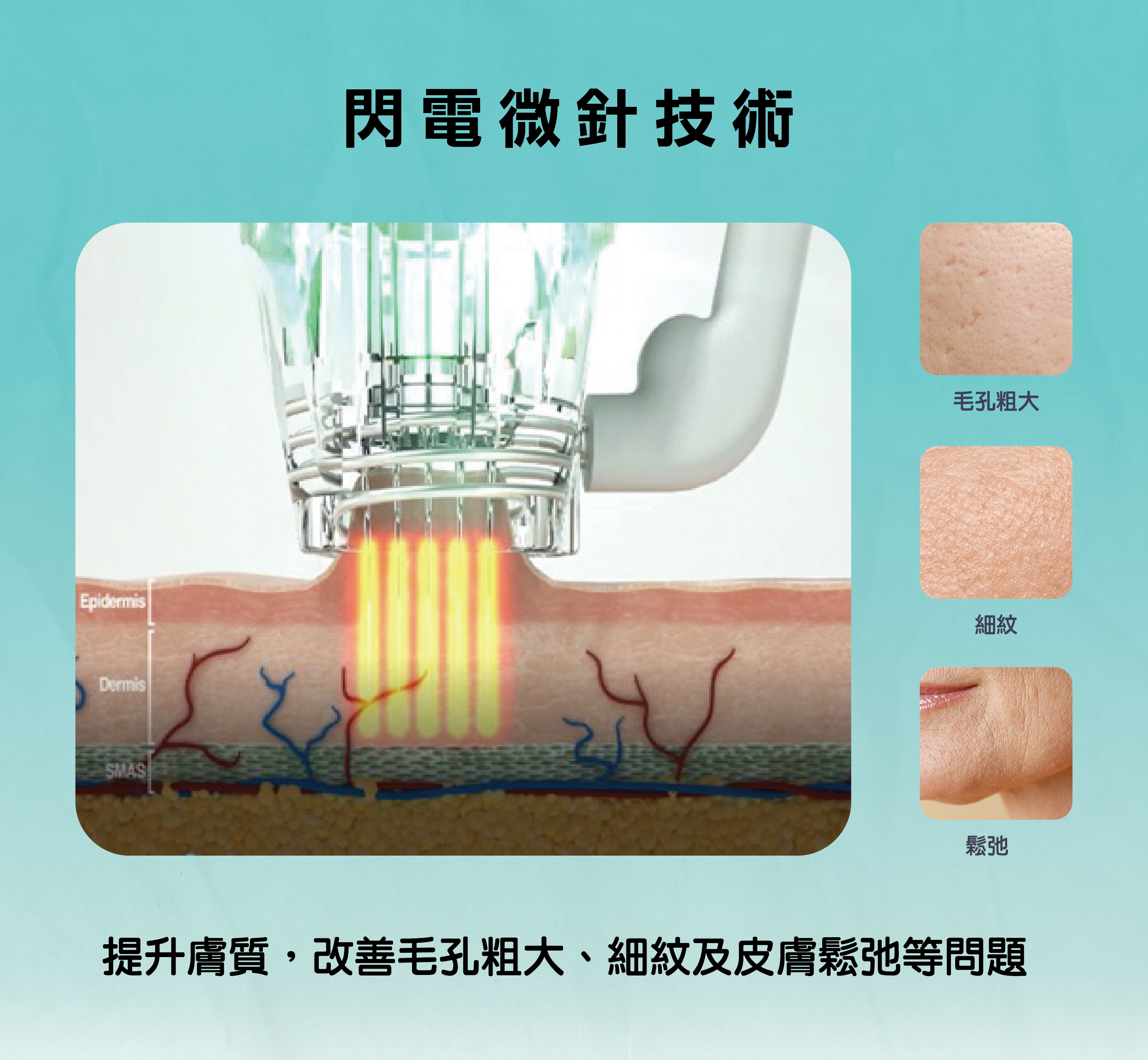 閃電音波技術（Ultrasound Therapy）