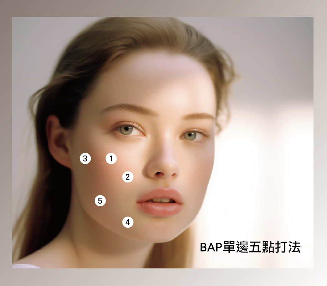 PROFHILO逆時針 BAP生物美學點注射技術臉部5點位置示意圖 PROFHILO逆時針 BAP生物美學點注射技術臉部5點位置示意圖