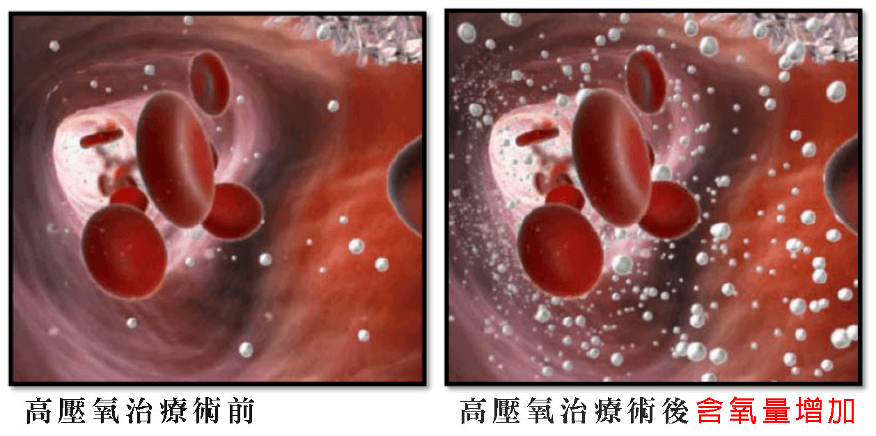 高壓氧治療示意圖