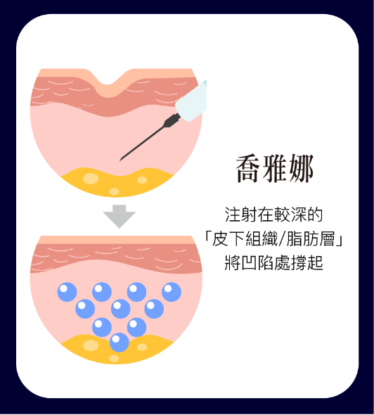 喬雅露與喬雅娜注射層次比較圖