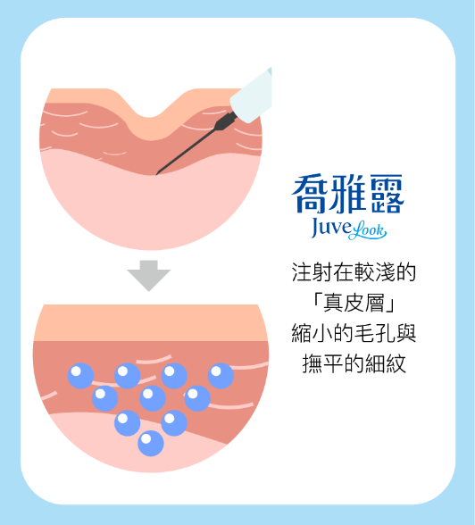 喬雅露與喬雅娜注射層次比較圖