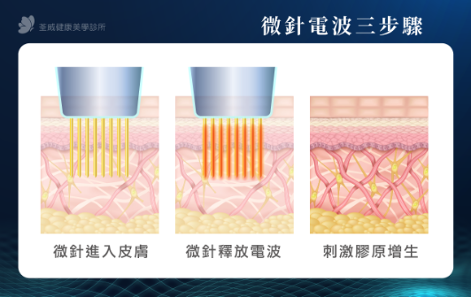 微針電波三步驟