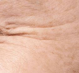 肌膚鬆弛與細紋