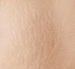 妊娠紋與生長紋