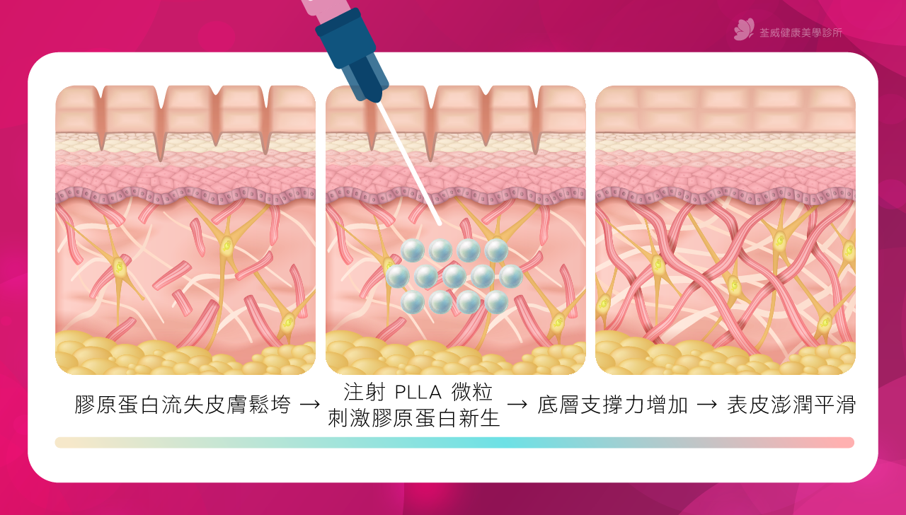 刺激膠原蛋白新生 → 底層支撐力增加 → 表皮澎潤平滑 刺激膠原蛋白新生 → 底層支撐力增加 → 表皮澎潤平滑