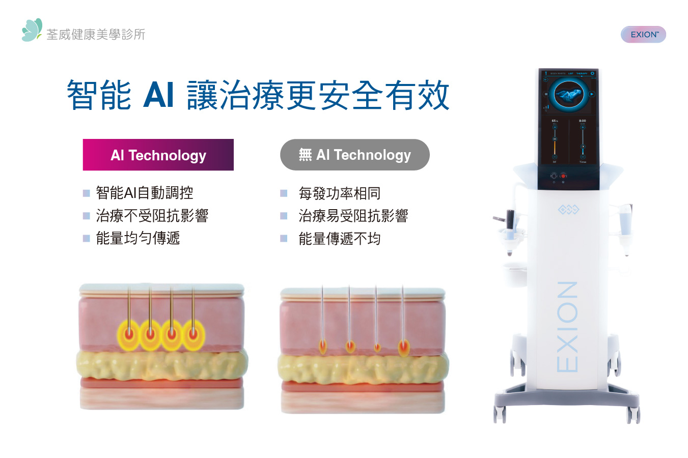EXION 時空E電波｜荃威診所