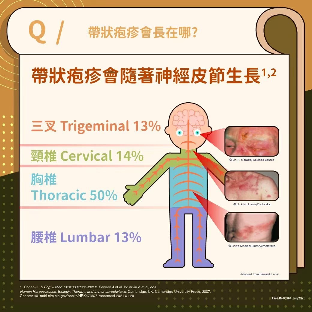 帶狀疱疹