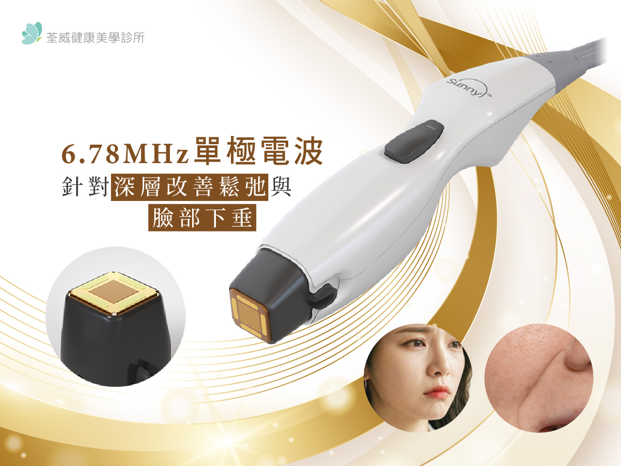 Sunny RF 索拉電波最新上市！愛美不再怕痛？雙模態電波原理、價格與評價一篇看懂！