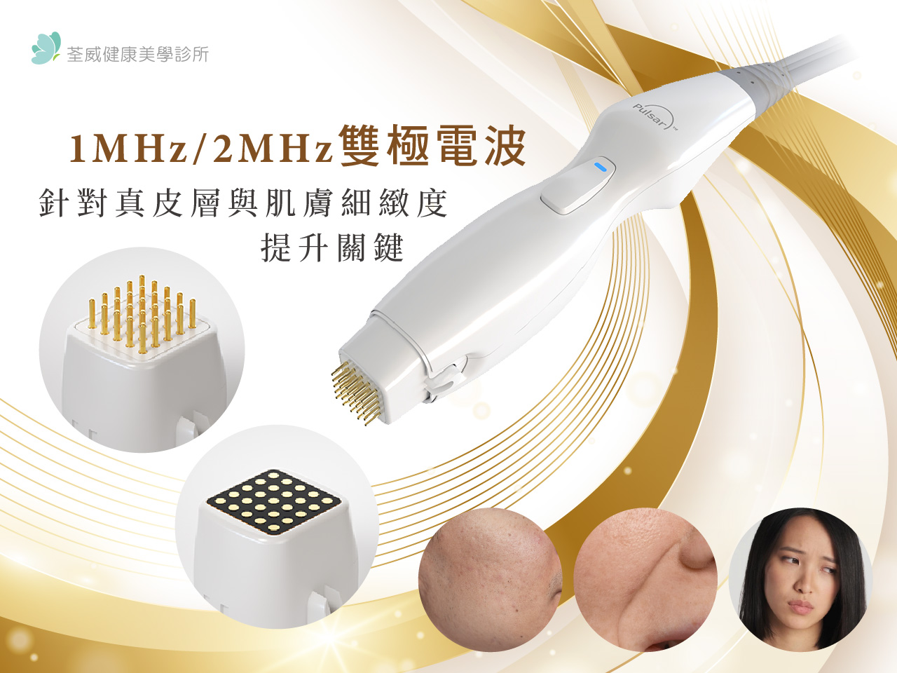 Sunny RF 索拉電波最新上市！愛美不再怕痛？雙模態電波原理、價格與評價一篇看懂！