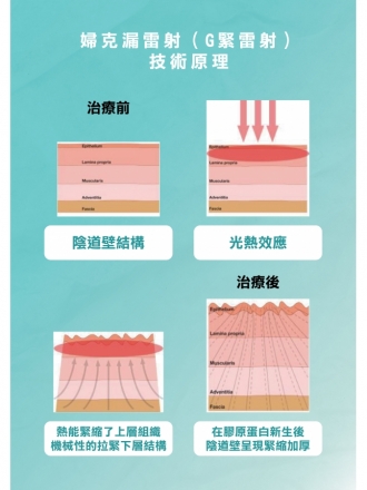 婦克漏雷射（G緊雷射）｜重拾青春活力，改善女性私密健康