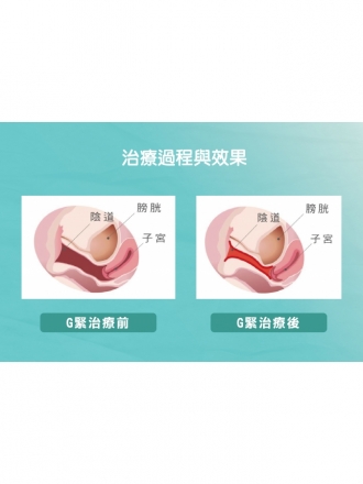 婦克漏雷射（G緊雷射）｜重拾青春活力，改善女性私密健康