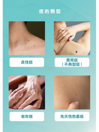 FOTONA 除痣