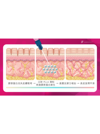 什麼是「4D童顏」？原理大公開