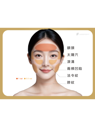 三、 哪些部位適合使用妮芙蕾？打造全臉立體美學