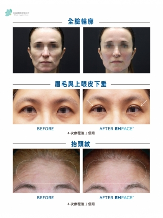 EMFACE 菲斯波｜荃威診所・頂級抗老首選