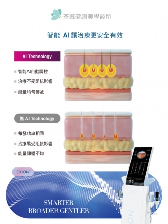 EXION 時空E電波｜荃威診所